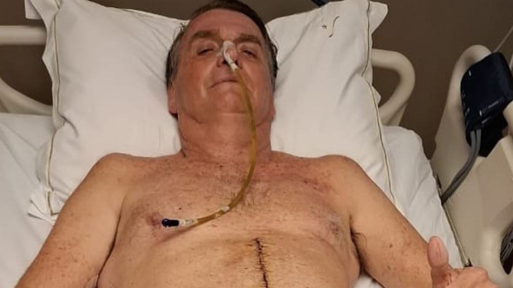 Recuperação Lenta: Bolsonaro Exibe Cicatriz e Detalha Estado de Saúde Após Cirurgia