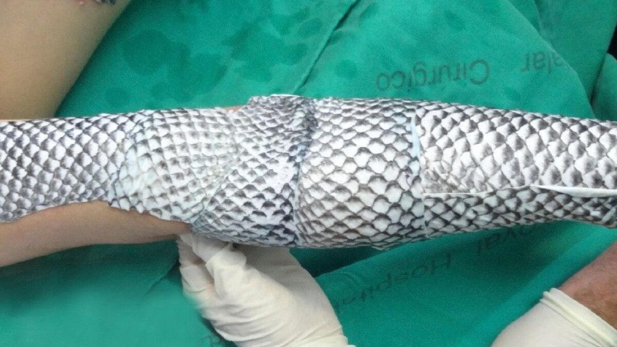 Pele de Tilápia Revoluciona Tratamento de Queimaduras de 2º e 3º Graus em Fortaleza e Devolve Esperança a Centenas de Pacientes
