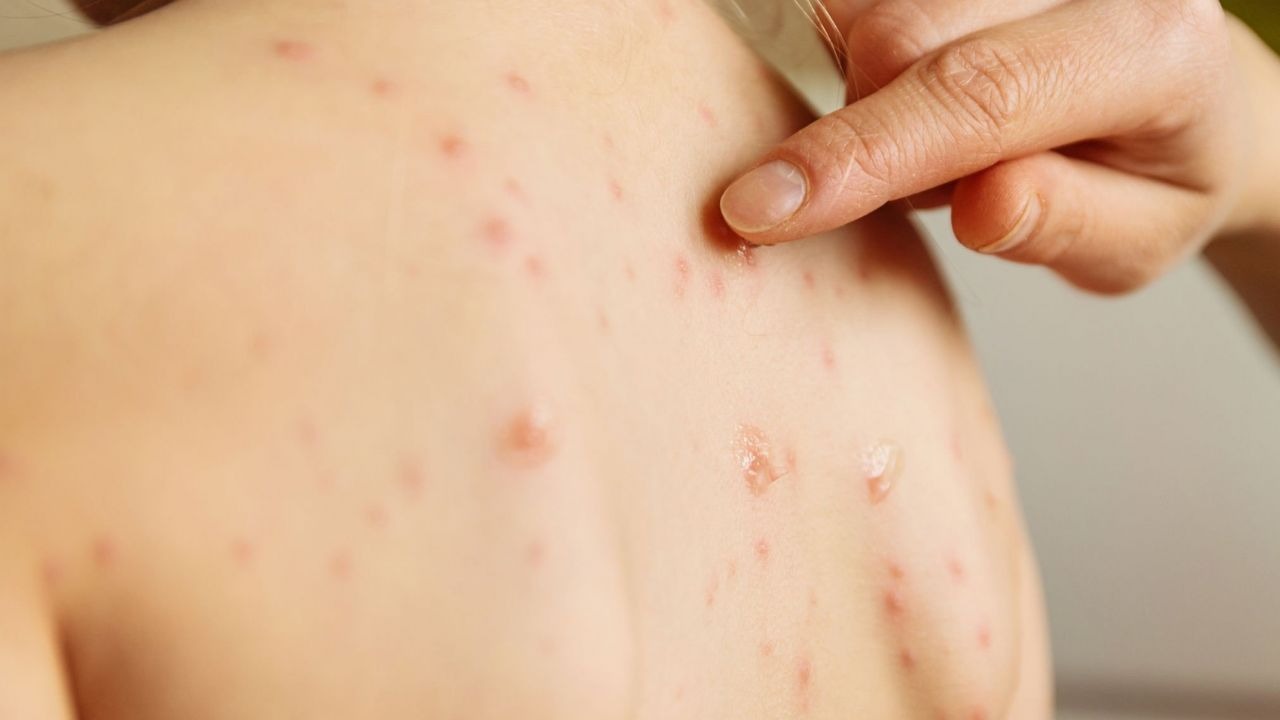 Alerta na Pele: Médico Viraliza Checklist Simples para Identificar Sinais de Câncer!