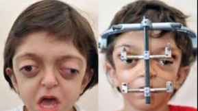 Pequeno Guerreiro Supera Desafios: Menino com Síndrome Rara Impressiona Após Cirurgia Reconstrutiva