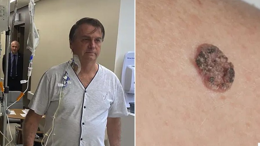 Imagem de destaque: O diagnóstico que abala a política: Bolsonaro está com câncer